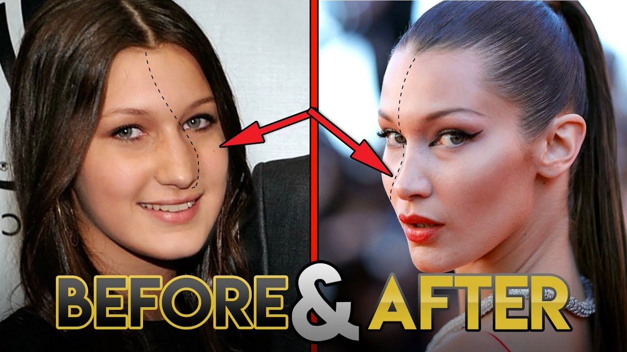 Bella Hadid | Before and After Transformations ( Plastic Surgery